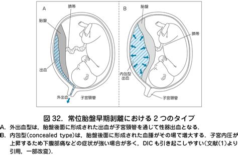 胎盤剝離後期|【医師監修】「常位胎盤早期剥離」は赤ちゃんとママ。